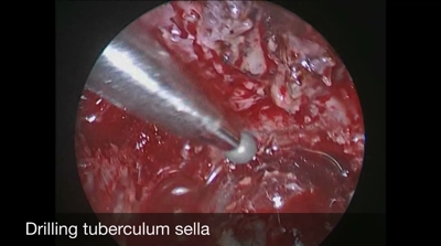 Thumb example of endoscopic approach media1