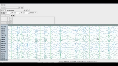 Thumb case 1 video eeg  de identified res